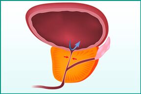 Prostate enlargement and compression of the urethra