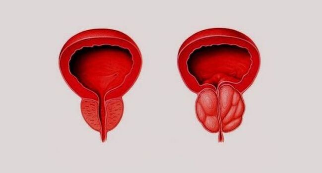 Healthy prostate (left) and inflamed by prostatitis (right)