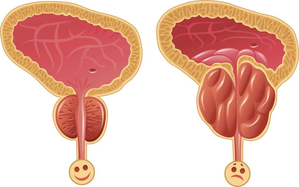 healthy and sick prostate