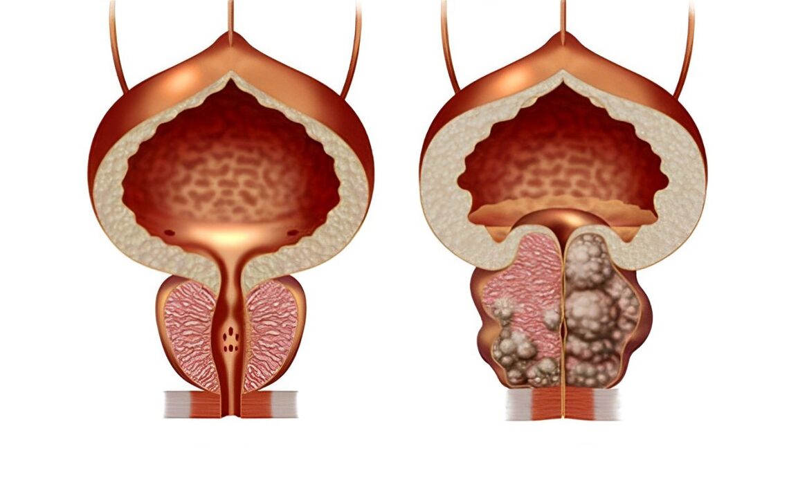 What does prostate adenoma look like 