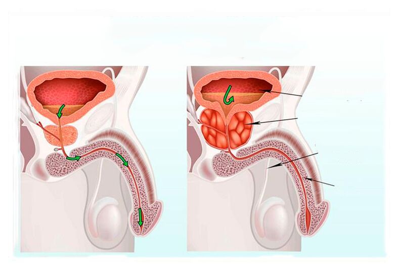 standard and inflammation of the prostate gland