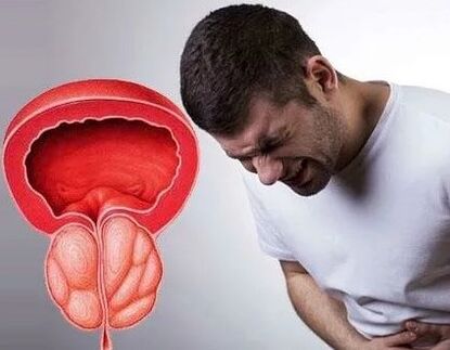 Chronic prostatitis symptoms in men