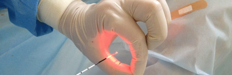 An effective method to treat prostatitis in men using laser.